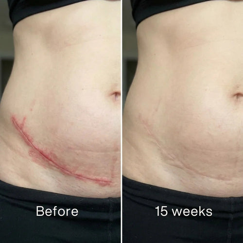 Silicone Scar Advanced Medical Repair Treatment